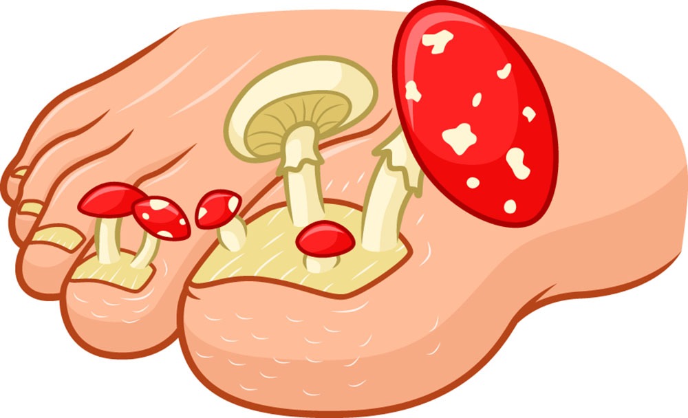 O infecție încăpățânată: ciuperca unghiilor