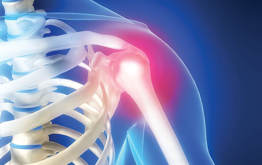 Dureri de umăr: cauze, diagnostic, tratament
